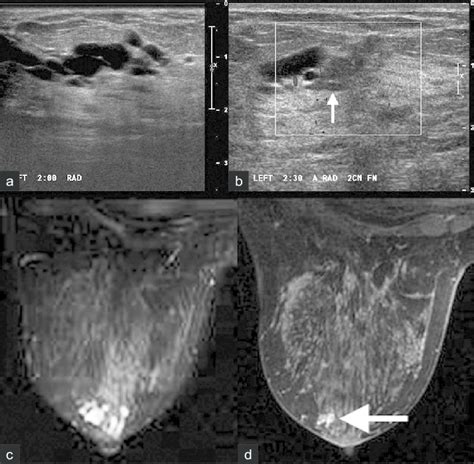 Intraductal papilloma.  a  Grayscale and  b  color Doppler ...