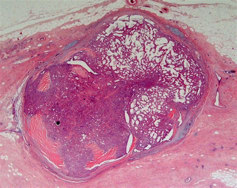 Intraductal papilloma of breast pathology outlines ...