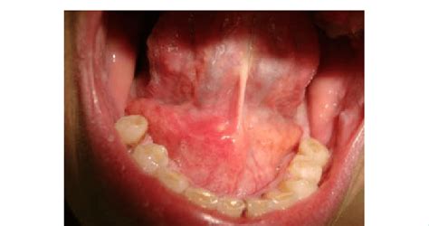 Intraoral aspect showing reddish swelling near the exit of the ...