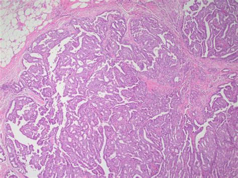 Invasive Papillary Carcinoma of Breast