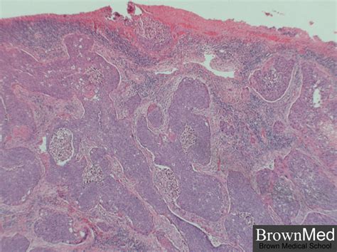 Invasive squamous cell carcinoma of the cervix