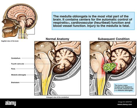 Invasive Tumor of the Brainstem Stock Photo: 7712408   Alamy