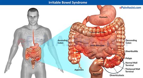 Irritable bowel syndrome Symptoms causes and Treatment ...