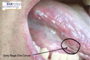 Is It Oral Cancer? | Six Step Screening