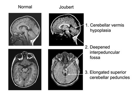 Joubert Syndrome   UW Hindbrain Malformation Research Program