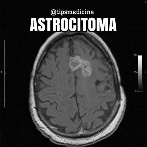 Juliogran   Astrocitoma #TipsMedicina #Neurología Son las...