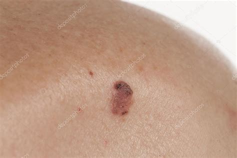 keratinizing squamous cell carcinoma of the skin — Stock ...