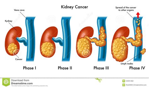 Kidney cancer stock vector. Illustration of lymph ...