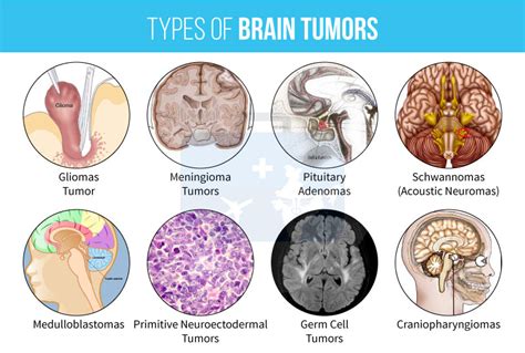 Know more about TYPES OF BRAIN TUMORS   Medikoe