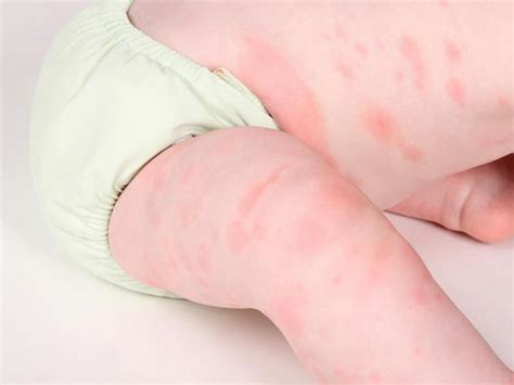 La alergia al gluten del niño: síntomas, diagnóstico, tratamiento