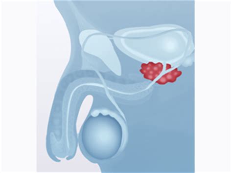 La circuncisión previene el cáncer de próstata
