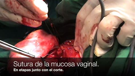 La cirugía del prolapso vaginal   YouTube