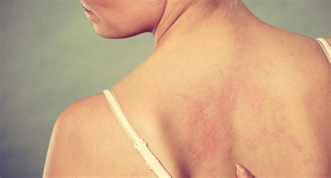 La dermatitis atópica es una enfermedad inflamatoria de la piel difícil ...