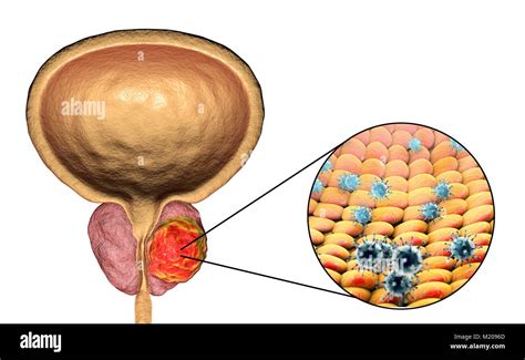 La etiología viral del cáncer de próstata. Ilustración conceptual ...