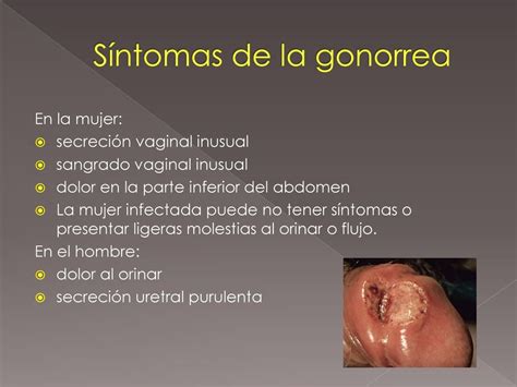La Gonor Sã­Ntomas De Gonorrea | Gonorrea