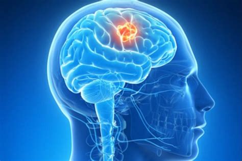 La inmunoterapia puede ser eficaz en un tumor cerebral que ...