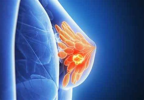La metástasis del cáncer de mama podría ser frenada