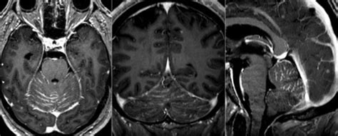 la neuroimagen: Carcinomatosis leptomeníngea ...