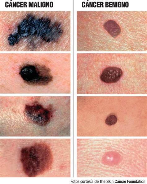 La piel, signos de alarma del cáncer | La Raza del Noroeste