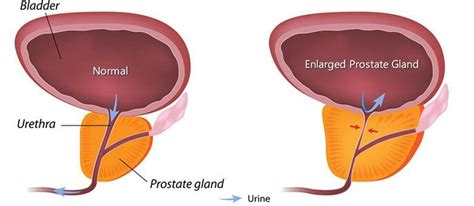 La próstata: Síntomas, consecuencias y tratamiento | Salud