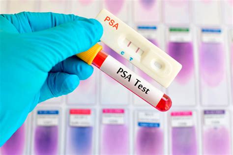 La prueba del PSA reduce el riesgo de fallecer por cáncer ...