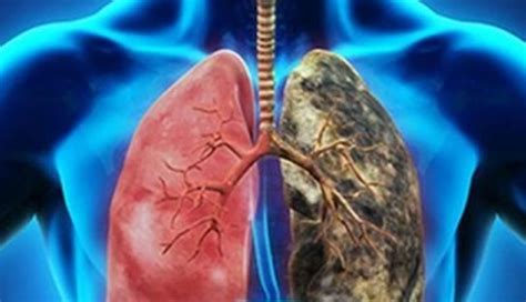 La prueba que anticipa el cáncer de pulmón – SALUD primero ...