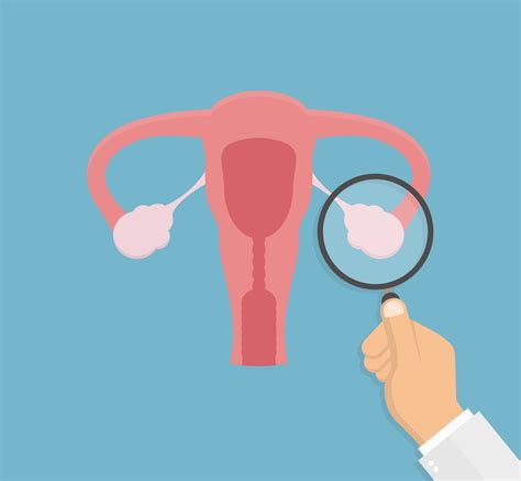 La salud de los ovarios y cáncer de ovario