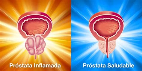 La solución a la próstata inflamada – prostakin