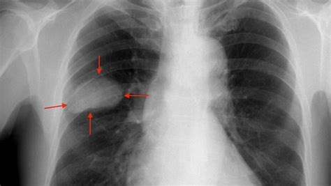 La supervivencia del cáncer de pulmón avanzado empieza a ...