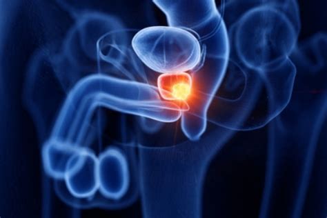 La terapia hormonal para el cáncer de próstata aumenta el riesgo de ...