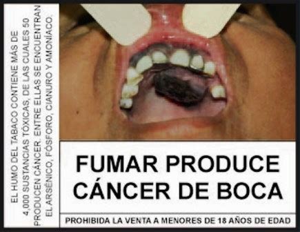 La vida cotidiana en tu salud: Tabaquismo y el cáncer bucal