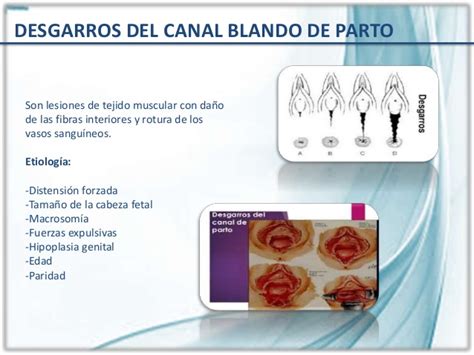 LACERACIONES DEL CANAL DE PARTO PDF