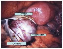 Laparoscopia cirugia ginecologica : TERATOMA EN OVARIO