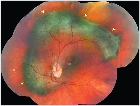Large Combined Hamartoma of the Retina and the Retinal Pigment ...