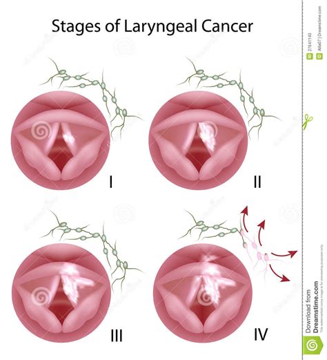 Laryngeal cancer stock vector. Illustration of disease ...