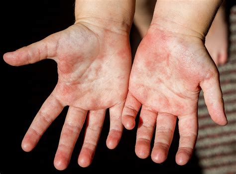 Las 10 enfermedades de la piel más comunes en niños   Eres Mamá