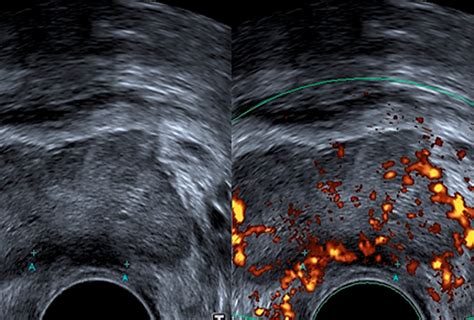Las aplicaciones de la ecografía transrectal en el cáncer de próstata