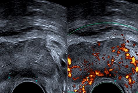 Las aplicaciones de la ecografía transrectal en el cáncer de próstata