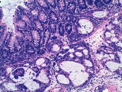 Las células tumorales de colon con metástasis en el hígado ...