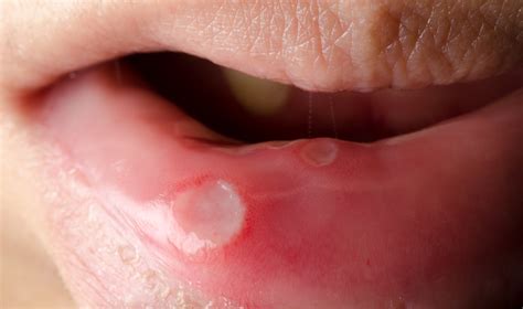 Las pequeñas lesiones o llagas en la boca podrían ser ...