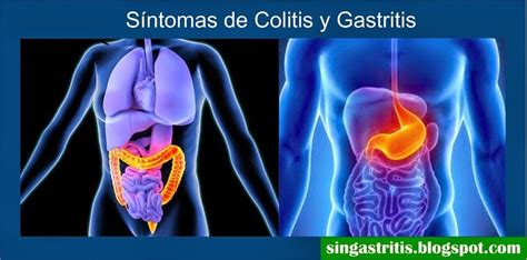 Las principales diferencias de síntomas de la colitis y la gastritis ...