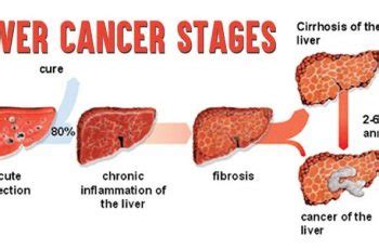 Last Stages Of Liver Cancer Before Death   Cancer News Update