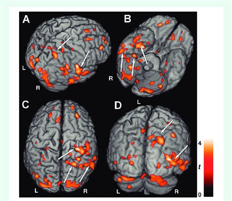 Lateralized cerebral blood flow  CBF  changes in heart ...
