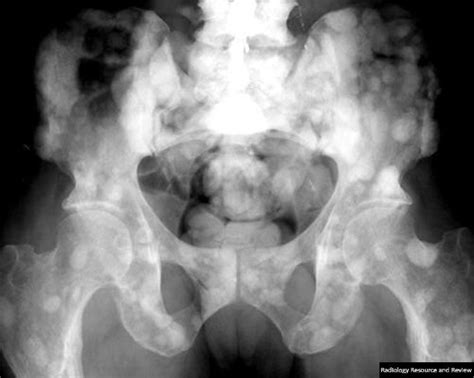 Learning Radiology   Metastatic, Disease, Bone