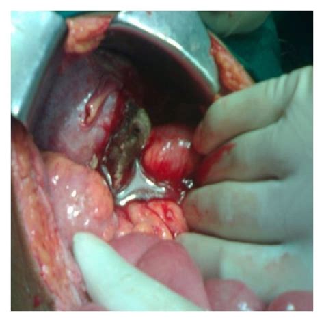 Left ovarian teratoma infiltrating into sigmoid colon. | Download ...