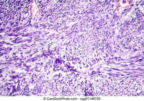 Leiomyoma, o fibroides, es un tumor muscular benigno, micrografo ligero ...