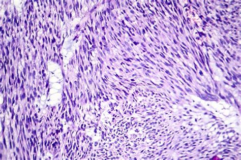 Leiomyoma, O Los Fibroids, Es Un Tumor Benigno Del Músculo Liso Imagen ...