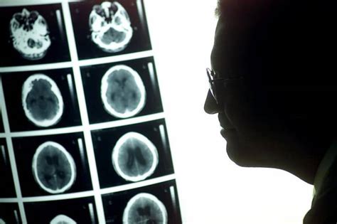 Lesión «epigenética» que predice tumores cerebrales, mayor ...