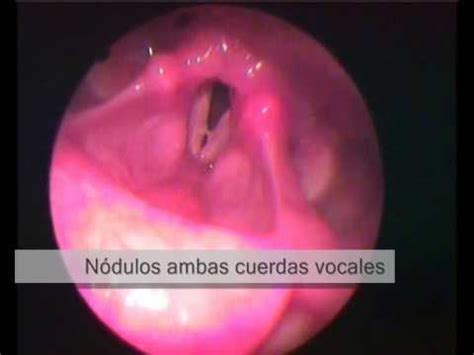 Lesiones en cuerdas vocales y laringe   YouTube