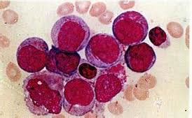 Leucemia mieloide aguda: ¿qué es? Causas, síntomas ...